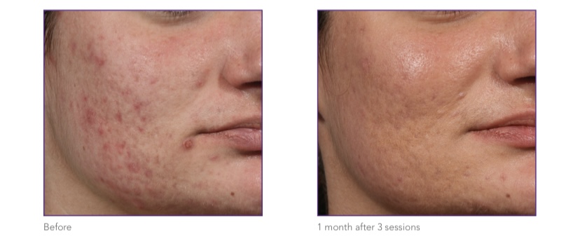 INTENSIF–RF MICRONEEDLING1